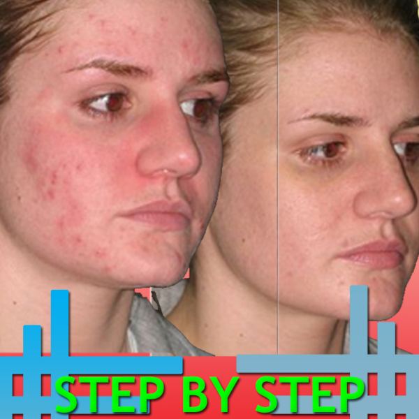 Step-By-Step Acne Treatment Access